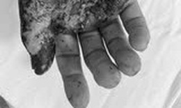 Tự đắp l&#225; thuốc tại nh&#224;, người phụ nữ bị biến chứng nghi&#234;m trọng