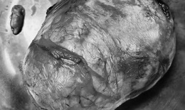 Bụng to bất thường, đi kh&#225;m ph&#225;t hiện khối u xơ tử cung khổng lồ