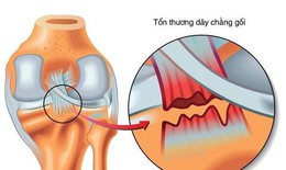R&#225;ch d&#226;y chằng c&#243; liền lại kh&#244;ng?