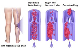 Các yếu tố nguy cơ gây bệnh huyết khối tĩnh mạch sâu