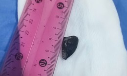 Bất ngờ phát hiện hạt hồng xiêm bị 'bỏ quên' hơn 10 năm trong phế quản