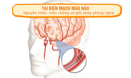 Tai biến mạch máu não: Nguyên nhân, triệu chứng và giải pháp phòng ngừa