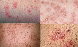 Điều trị viêm nang lông bằng thuốc - Khi nào cần sử dụng?