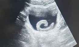 Người đàn ông phải nhập viện cấp cứu vì… đỉa sống trong bàng quang