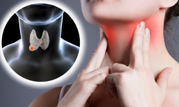 Chuyên gia chỉ cách ổn định nhân tuyến giáp: Không to lên, không biến chứng