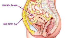 6 điều bạn nên làm để giảm mỡ nội tạng hiệu quả, bền vững