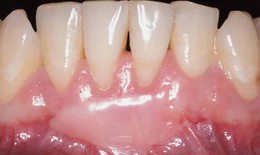 Những điều nên và không nên sau ghép lợi