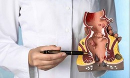 Trĩ nội độ 2 có cần mổ không?