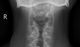 Đau cột sống cổ âm ỉ 5 tháng, nam thanh niên 26 tuổi phát hiện viêm cột sống dính khớp