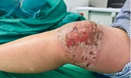 Viêm da, nhiễm trùng nặng do tự đắp thuốc nam, thuốc lá để điều trị đau khớp