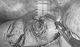 Phẫu thuật nội soi cấp cứu thành công cho nam thanh niên bị đinh xuyên thủng ruột non 