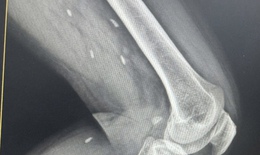 
Phát hiện nhiều kén sán ở chân bệnh nhân do một thói quen thường gặp