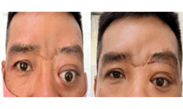 Bệnh hiếm gây lồi mắt, 20 năm Bệnh viện Tai Mũi Họng TPHCM chỉ gặp 2 ca