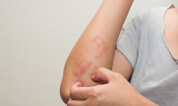 Viêm da dị ứng kiêng gì?