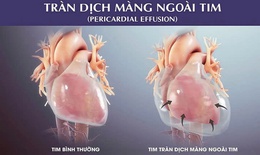 Cấp cứu bệnh nhi bị tràn dịch màng ngoài tim nguy kịch
