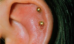 Sưng, đỏ vành tai cảnh giác với viêm sụn vành tai