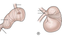 Xoắn dạ dày ở trẻ em rất nguy hiểm, cha mẹ cần phát hiện sớm