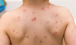 3 bệnh thường gặp ở trẻ vào mùa xuân