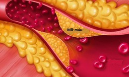 Tăng triglycerid máu gây nhiều hệ lụy và phòng ngừa hiệu quả