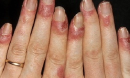 Cách chữa cước tay chân mùa đông tại nhà