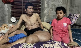 Người đàn ông có khối u khổng lồ đau xót nhìn vợ con lay lắt vì bệnh tật