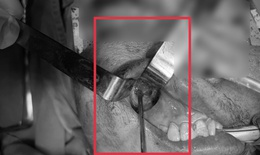 Nấm đen 'ăn' mòn xoang hàm người đàn ông khỏe mạnh