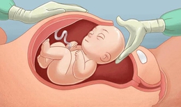 Yếu tố hình thành nhau cài răng lược - mối nguy hiểm trong thai kỳ