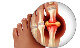 Bị gout tái đi tái lại, chữa thế nào?