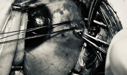 Bảo tồn nhãn cầu cho bệnh nhân bị đinh sắt bắn vào mắt