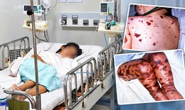 Bệnh não mô cầu có thể gây tử vong trong vài giờ