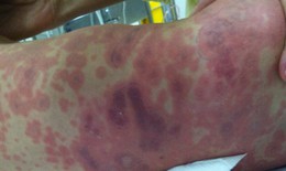 Ghi nhận học sinh thứ 4 mắc não mô cầu, dấu hiệu nào cần nhập viện?