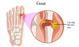 Vì sao người trẻ có thể mắc gout?
