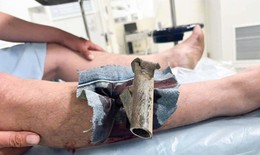 Chân chống xe máy găm cẳng chân, người đàn ông phải mang cả vào phòng cấp cứu