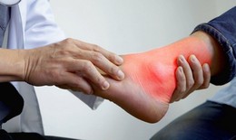 Bệnh gout không chỉ do ăn uống