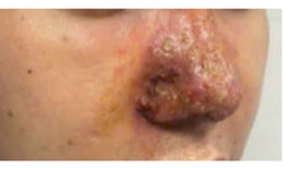 Mũi đầy mủ sau tiêm filler ở spa, bác sĩ cảnh báo biến chứng nguy hiểm