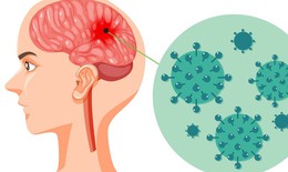 4 dấu hiệu đặc trưng cảnh báo bệnh não mô cầu cần chú ý