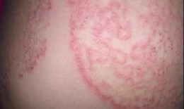 5 nguyên tắc quan trọng giúp phòng ngừa nấm da