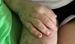 Ghi nhận hơn 1.800 ca tay chân miệng trong 1 tuần: Cảnh giác dấu hiệu bệnh chuyển nặng