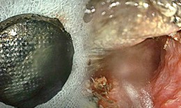 Trẻ bị tổn thương nghiêm trọng thực quản vì pin cúc áo, bác sĩ khuyến cáo