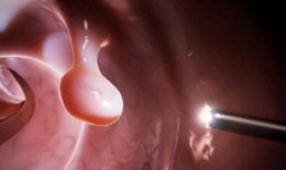 Đa polyp túi mật có nguy hiểm không?