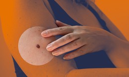 Vaccine ung thư mới giúp giảm 42% nguy cơ tái phát u hắc tố