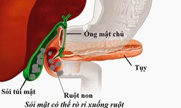 Sỏi túi mật khi nào cần mổ cấp cứu?
