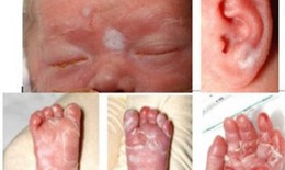 Bác sĩ chỉ cách phát hiện sớm và điều trị giang mai bẩm sinh