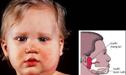 Bệnh quai bị bao lâu thì khỏi?