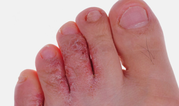Nhiễm nấm, viêm da mùa mưa cần cảnh giác khi độ ẩm tăng cao