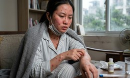 Cách điều trị bệnh thủy đậu tại nhà, ngăn ngừa sẹo