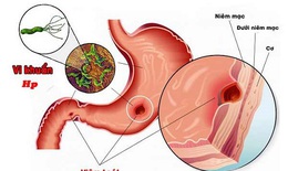 Tập luyện thể chất: Giải pháp không mất tiền phòng ngừa và hỗ trợ điều trị viêm loét dạ dày- tá tràng