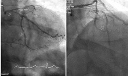 Can thiệp kịp thời cứu cụ ông 86 tuổi sốc tim nguy kịch