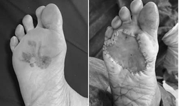 Vết đen ở bàn chân suốt 15 năm mới phát hiện ung thư