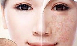 Nhận diện thủ phạm gây đốm đồi mồi trên da